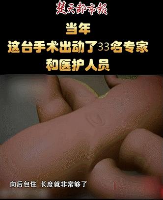 坐骨连体双胞胎多大分离,中国首例坐骨婴儿手术成功完整版