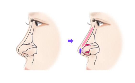 鞍鼻手术前后对比,鞍鼻矫正手术注意事项