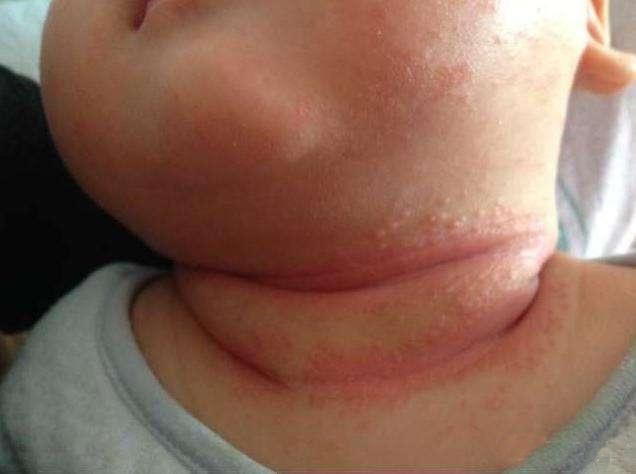 宝宝淹脖子推荐什么爽身粉,宝宝淹脖子爽身粉