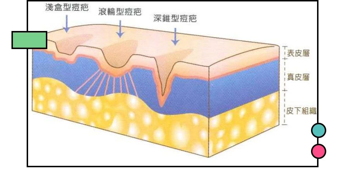十大公认祛痘印效果最好的方法,教你几招祛痘印的最快方法