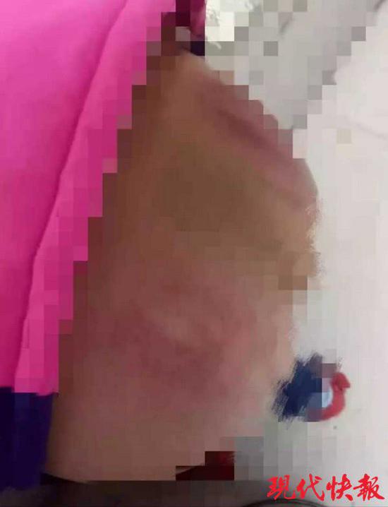 幼儿园学生被老师打的浑身淤青,5岁孩子17天被幼儿园老师打130次