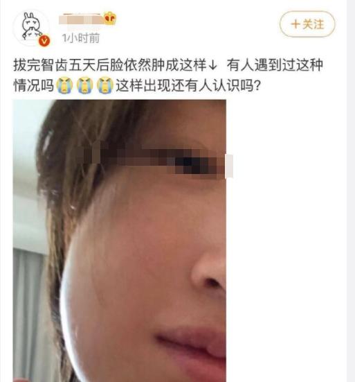 拔完智齿第5天了脸部发肿正常吗,拔完智齿一个月脸部还是有些肿