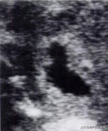 3毫米卵黄囊未见胎芽正常么,40多天的卵黄囊