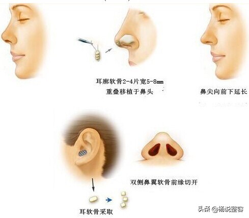 隆鼻失败修复的几点建议,隆鼻失败医生会马上为患者修复吗