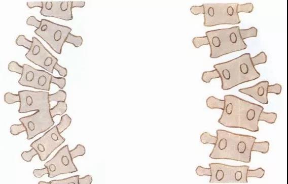 脊柱侧弯矫正视频教程完整,脊柱侧弯中医正骨矫正视频