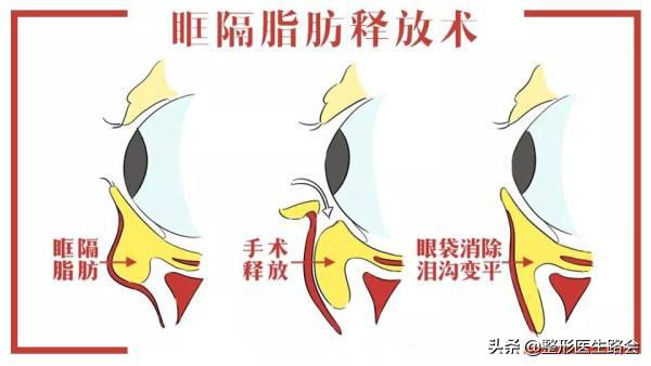 玻尿酸填充泪沟20多天了还有淤青,填充眼袋泪沟的淤青怎么才会消除