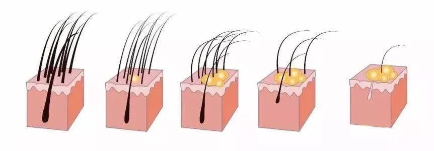 脂溢性脱发能治好吗知乎,脂溢性脱发能治好吗怎么治疗