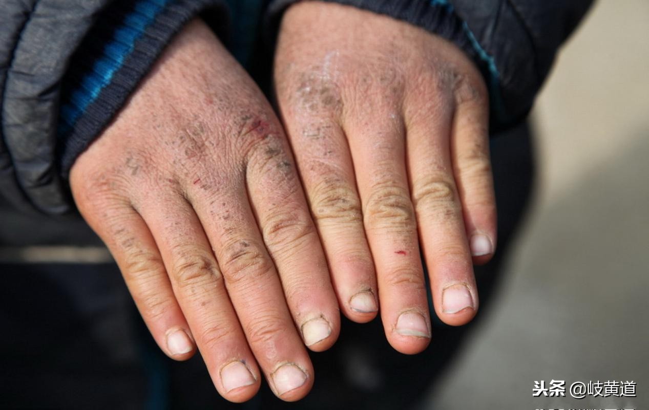 起了冻疮怎么办?4招巧预防,1点很关键