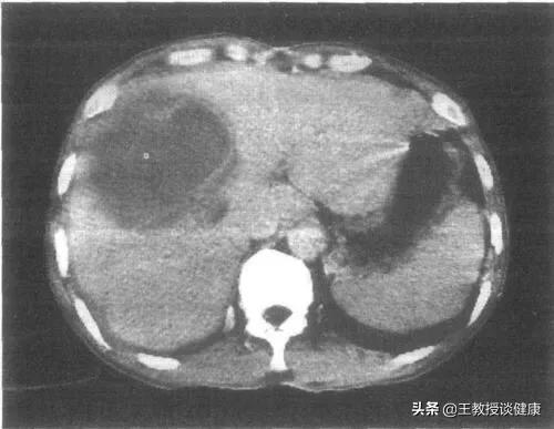 脓肿为什么会有硬结,肝脓肿和糖尿病的关系