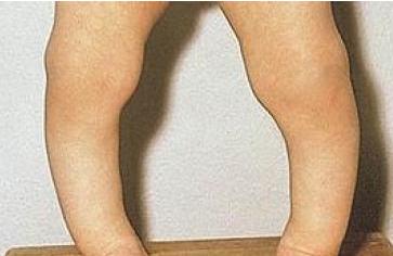 孩子佝偻病的表现怎么治疗,为什么小孩缺钙会得佝偻病