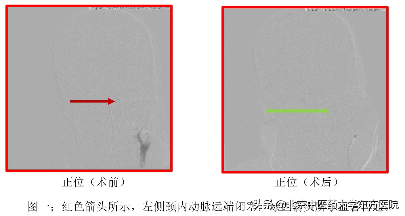 有一种脑梗塞,尽快取出血栓可避免永久性瘫痪