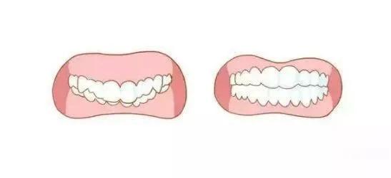 牙齿是深覆合必须要矫正吗,深覆合是要矫正牙还是做正颌手术