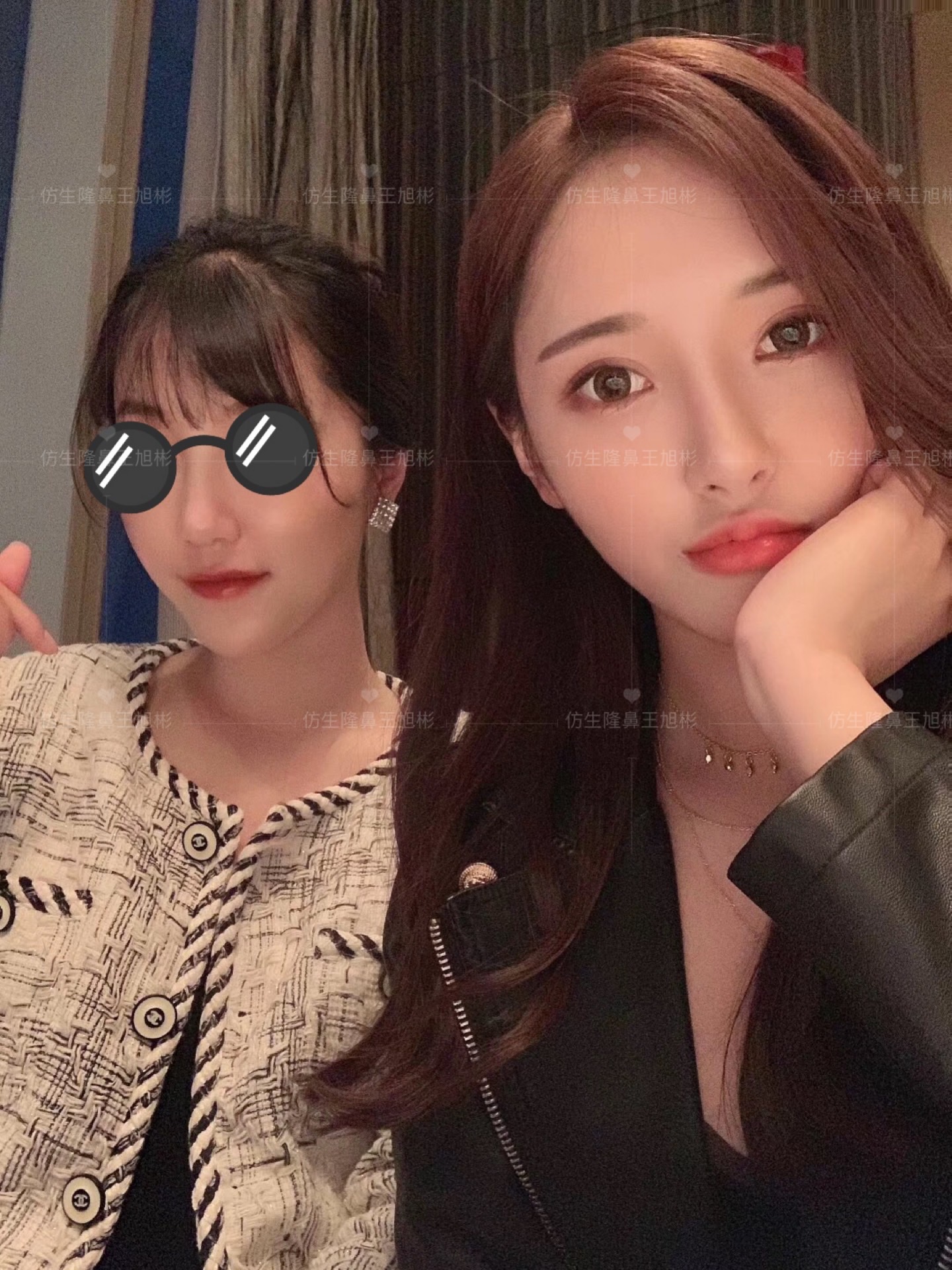 线雕隆鼻后鼻综合修复术,隆鼻失败修复手术真实案例