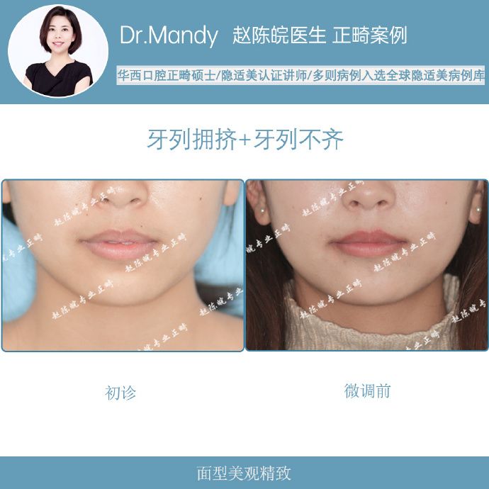 隐适美隐形矫正成功案例,经典隐形矫正