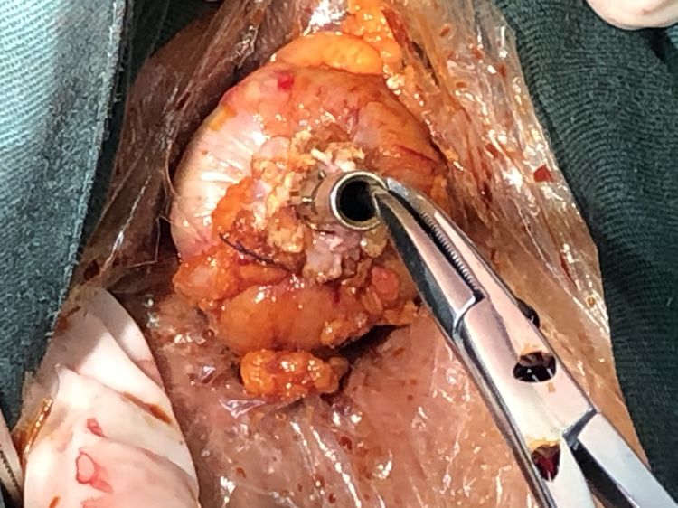 娓崡甯傜浜屽尰闄㈣偪鐦よ兏澶栫,鑲跨槫鍖婚櫌鑳镐簩澶栫