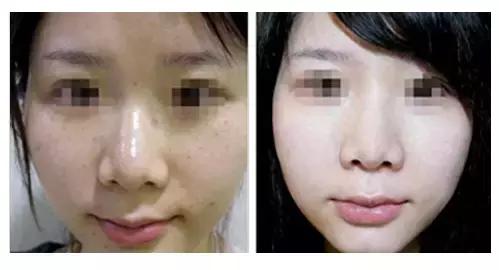 光子嫩肤和其他项目的区别,关于光子嫩肤的一些问题