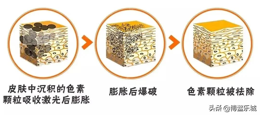 祛斑激光仪器评测,四合一otp激光祛斑仪