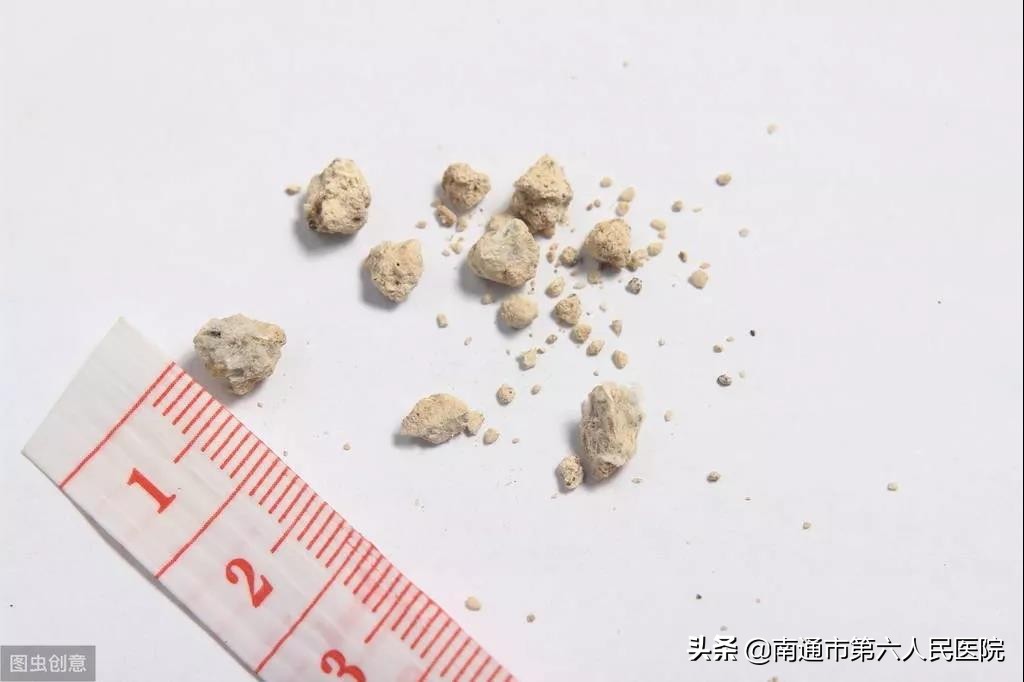 肾结石体外震波碎石治疗费用多少,肾结石在什么位置不能用体外碎石