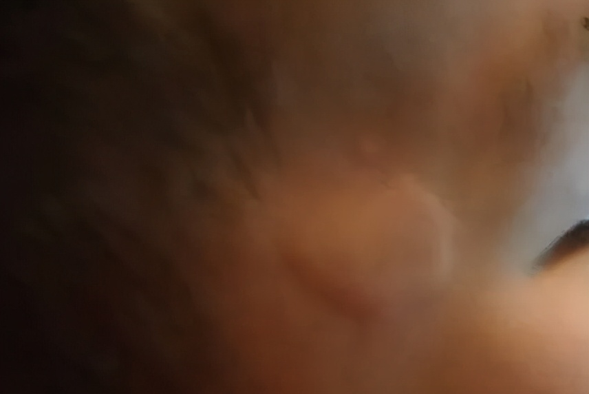 荨麻疹病例处理结果,麻疹病例处理