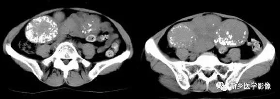 腹部平片能看到结石吗,腹部高密度结节影是什么