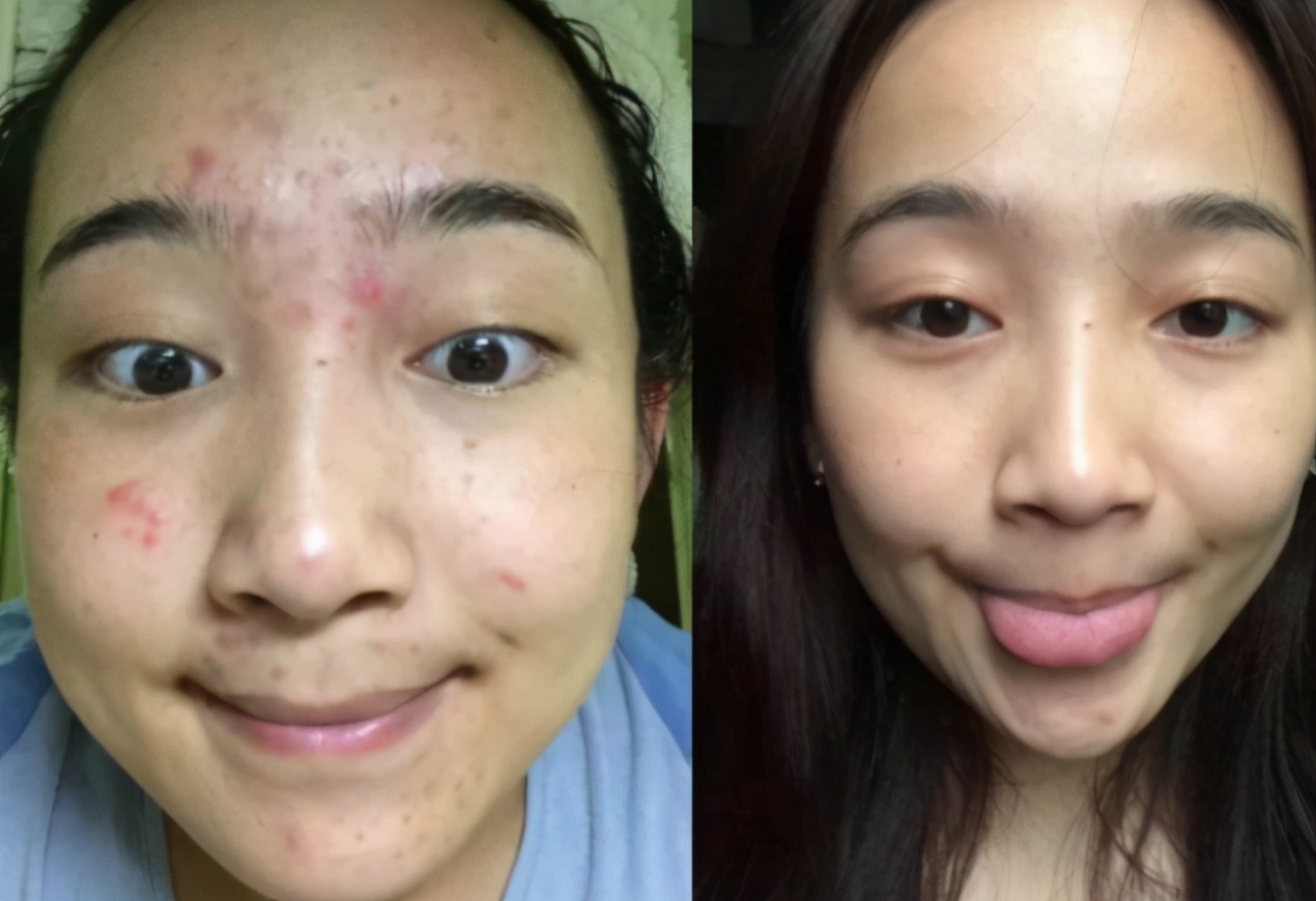 18岁脸上长痘的少女用什么护肤品,30多岁脸上反复长痘用什么护肤品