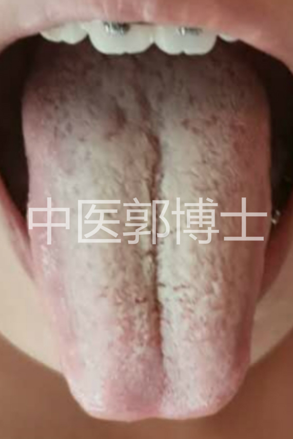 月经淋漓不尽喝中药后有血渣,例假淋漓不尽隔几天还流一股鲜血