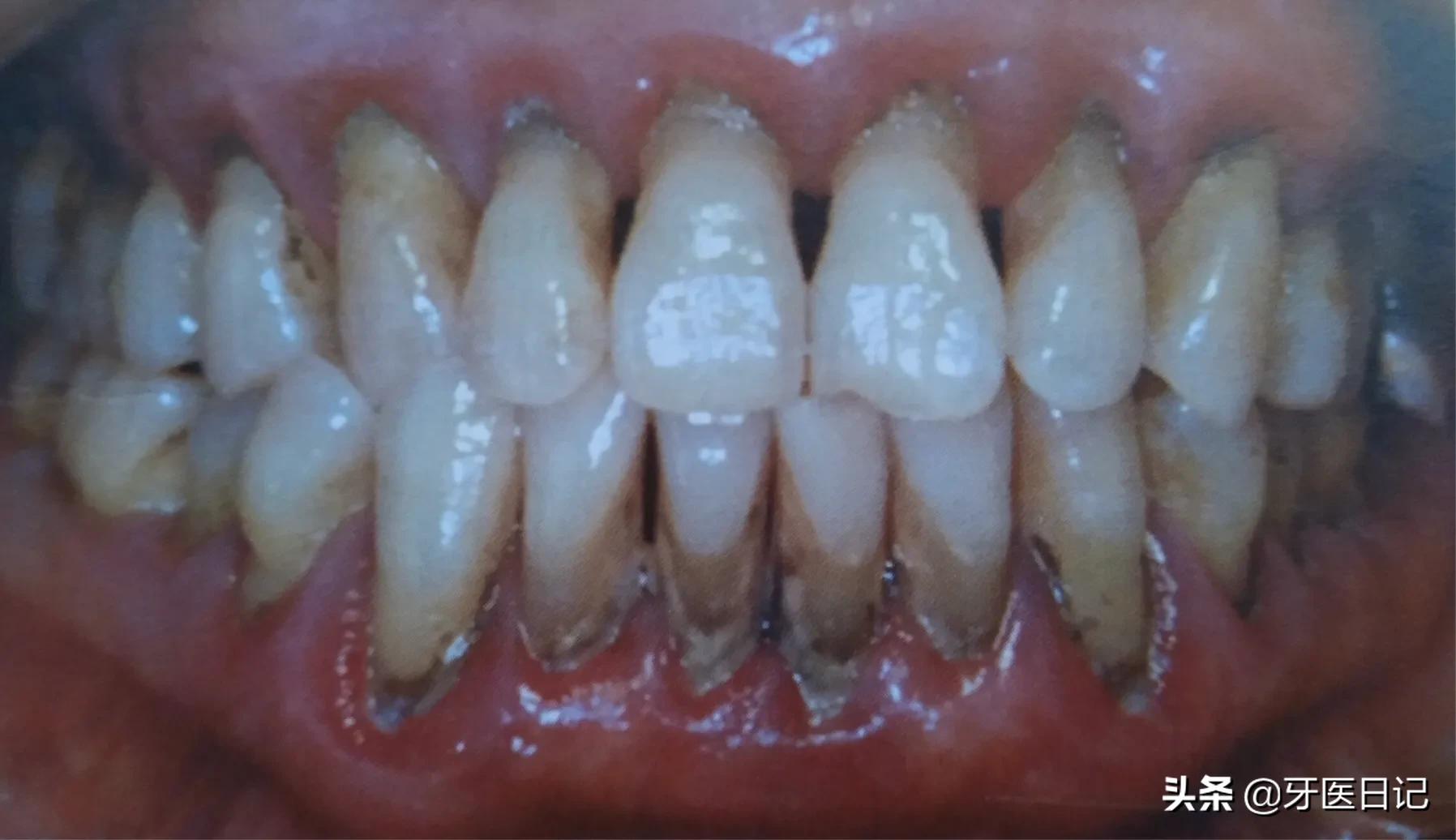 牙龈又红又肿，上火了吗？