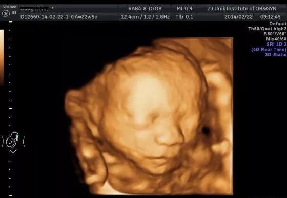 产检B超:二维、三维、四维超声有什么不一样?产检要做几次B超?