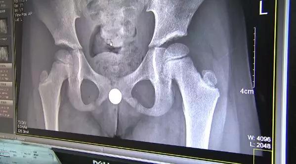 女孩肚子痛还流血，隔了几天走路都不对劲了！