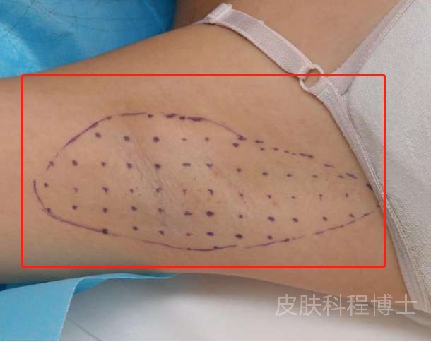 十岁女孩狐臭可以治疗吗,运动对狐臭的帮助