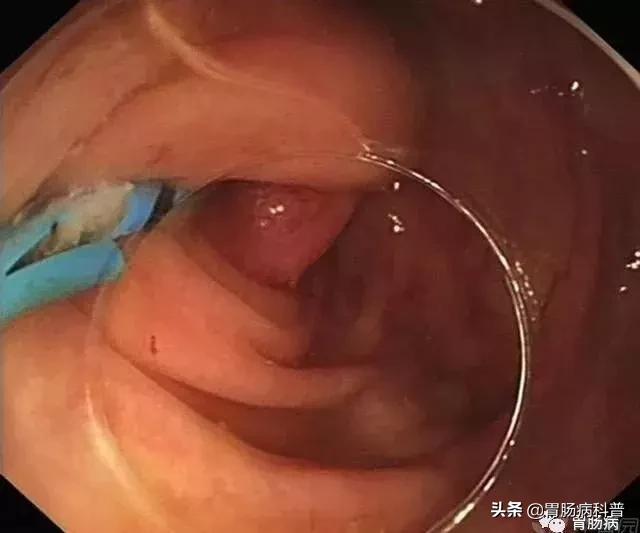 阑尾炎最新内镜微创手术,内镜下阑尾炎治疗术哪里可以做