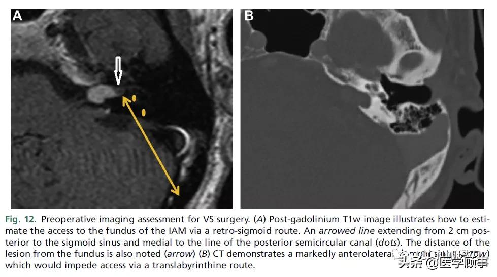 「综述」前庭神经鞘瘤的成像：诊断、监测、和治疗计划