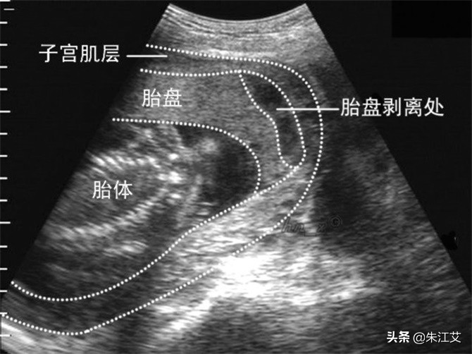 孕期出血一般是什么原因,孕期出血什么原因导致的