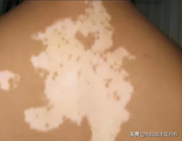 手部白癜风怎么鉴别,白癜风鉴别方法