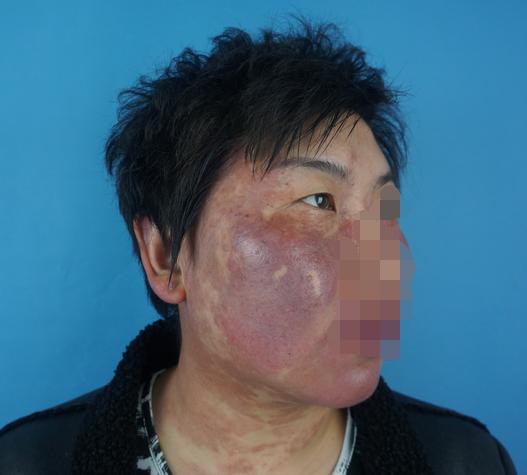 代涛博士的痣长在哪里,代涛博士鲜红斑痣