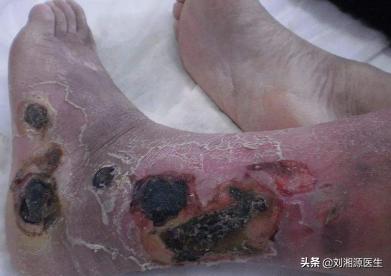 「免疫相关不良妊娠答疑解惑40」——系统性血管炎