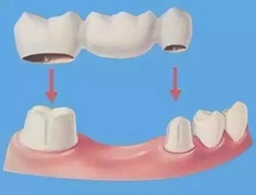 已经有牙洞了怎么根管治疗,牙髓腐烂坏死再做根管治疗会痛吗