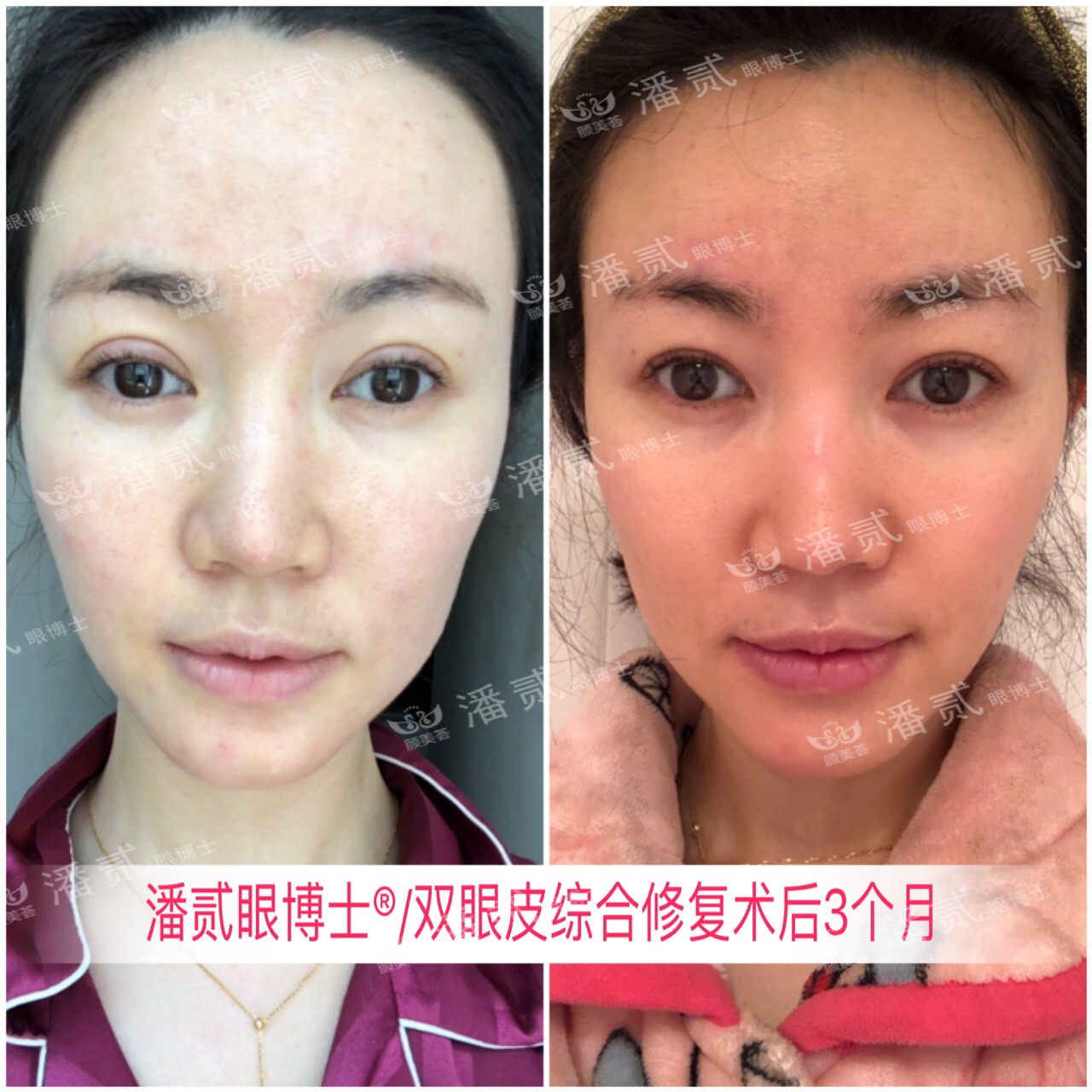 广州双眼皮修复内双,广州双眼皮修复可以只修眼尾吗