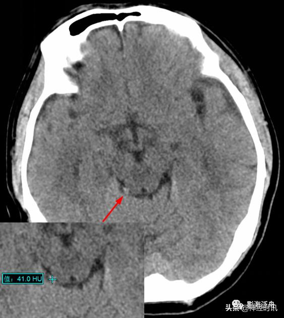 蛛血的临床表现,蛛血ct表现