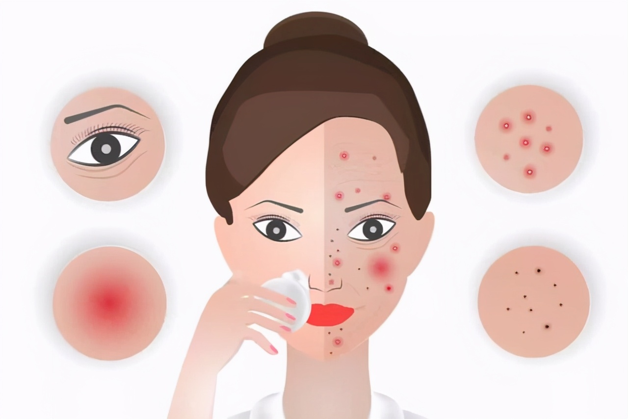 唇周黑敏感紧绷干燥起皮怎么办,脸起皮干燥紧绷刺痛发红用什么药