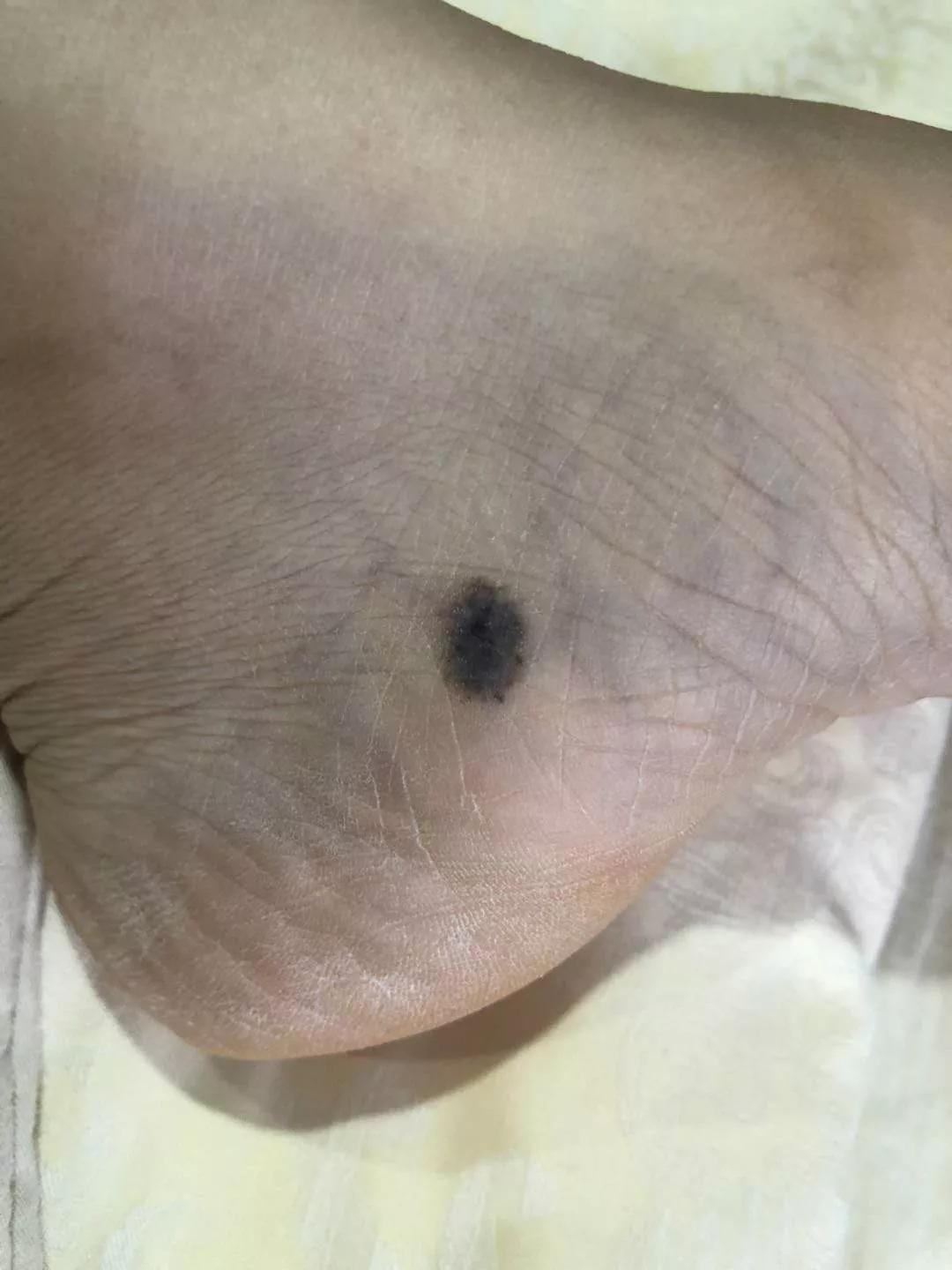 哪些黑痣容易恶变？需要切除吗？