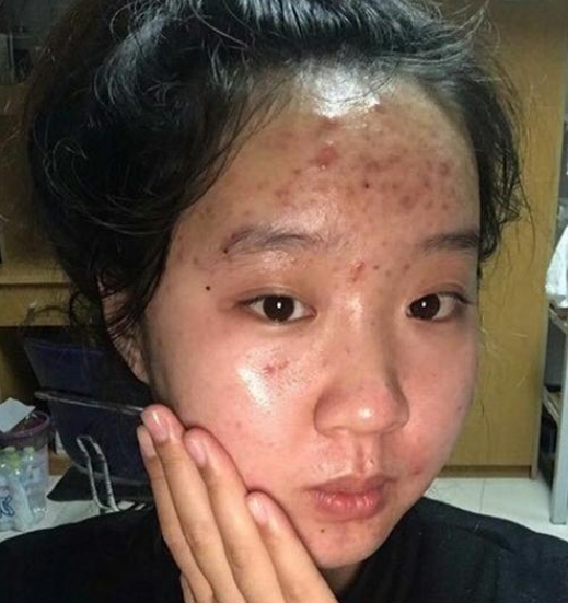 男生会喜欢脸上有痘的吗,男生会喜欢脸上有斑的女生吗