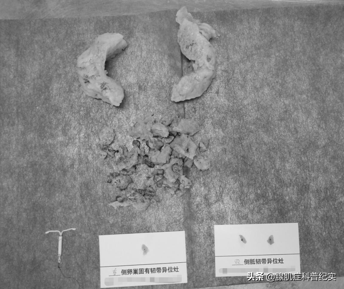 痛经做保宫手术有用吗,痛经能不能做微创手术