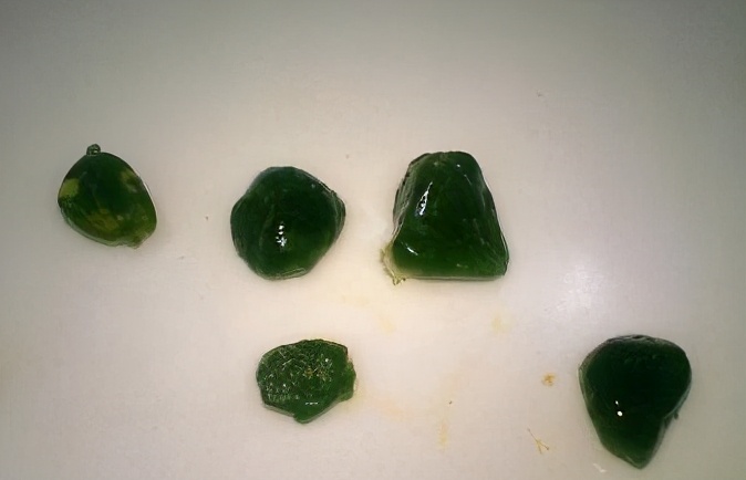 肾结石无创取石手术几天恢复,有肾结石不做手术怎么解决