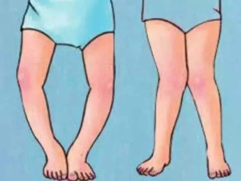 宝宝小腿弯弯怎么办,小腿弯曲导致罗圈腿怎么办