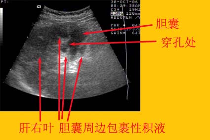 胆结石的原因及危害及治疗方法,胆结石是怎样形成的饮食注意什么