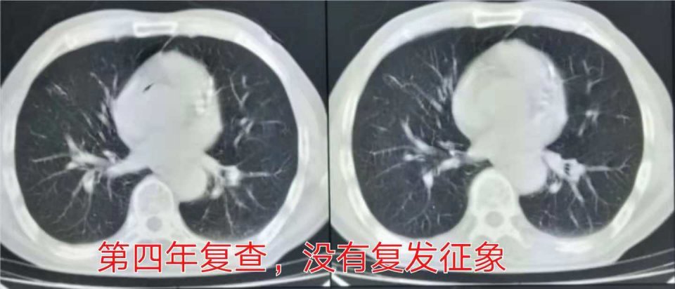 与肺癌病人一起生活需要注意什么,与肺癌抗战的第七个月