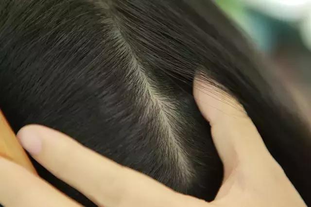 毛囊浅易脱发什么原因,毛囊需要什么营养才长头发
