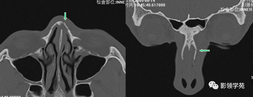 鼻骨影像学解剖,鼻骨解剖及骨折影像学诊断