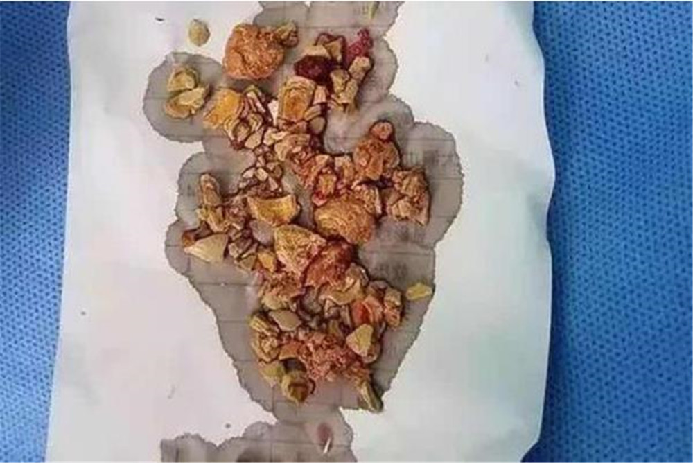 五个月宝宝肾结石竟是辅食惹的祸,5个月宝宝肾结石能喝奶粉吗